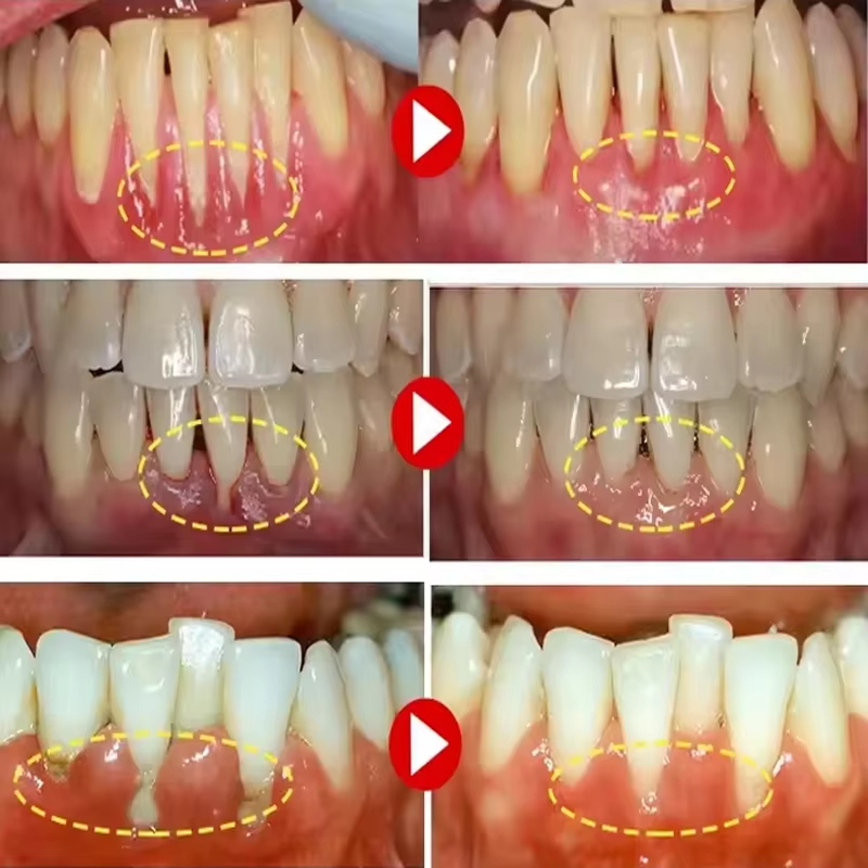 Tandenbleekgel Tandvleesrepara - Teeth Whitening Gels recensie en prijs