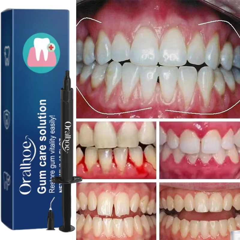 Tandenbleekgel Tandvleesrepara - Teeth Whitening Gels recensie en prijs