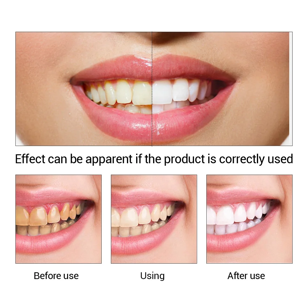 Fteenply Tanden Whitening Esse - Teeth Whitening Session recensie en prijs