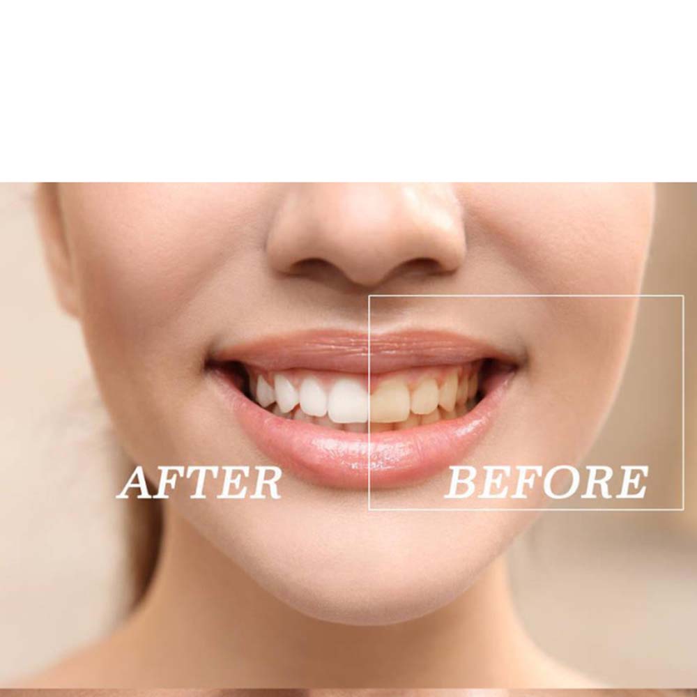 Topkwaliteit Peroxide Tanden W - Teeth Whitening Gels recensie en prijs