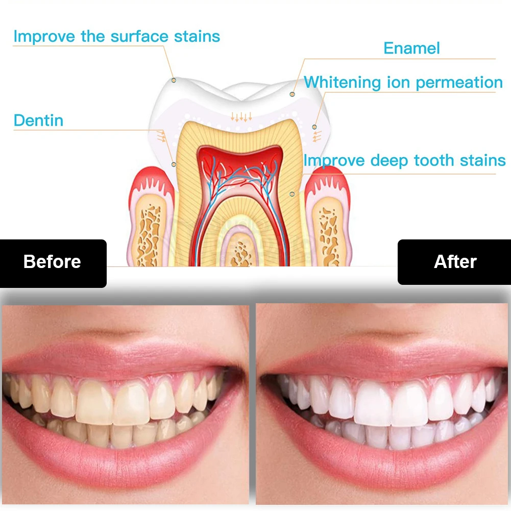 Tandheelkundige Tanden Whiteni - Teeth Whitening Device recensie en prijs